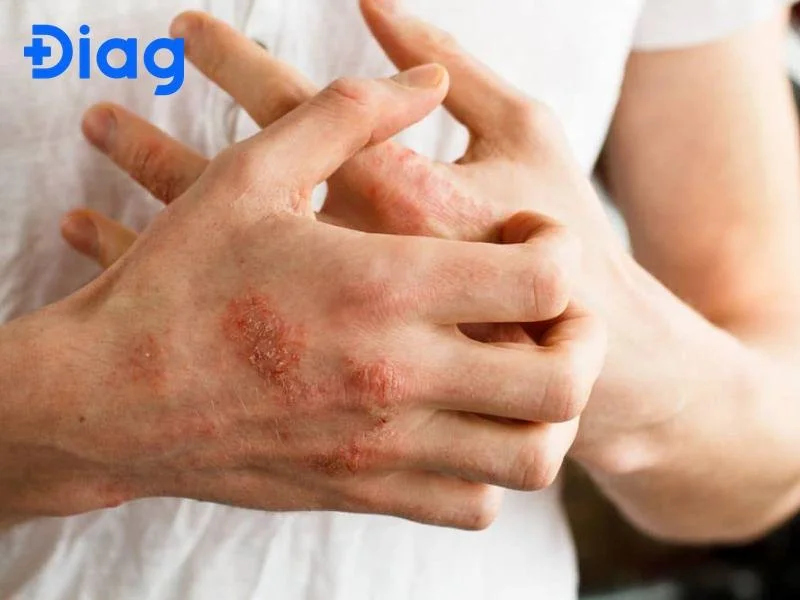 Dấu hiệu sán chó ở trẻ em và người lớn không nên bỏ qua