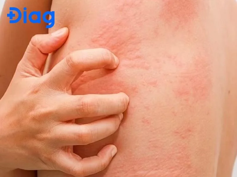 Cách giảm ngứa khi bị sán chó hiệu quả tại nhà dễ thực hiện