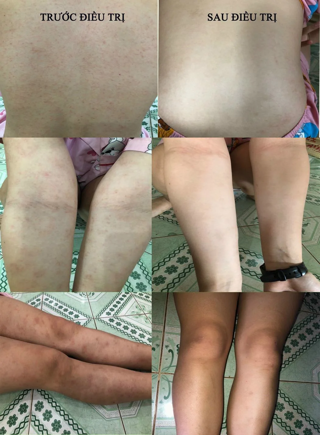 Điều Trị Bệnh Sán Chó: Dứt Điểm & Hiệu Quả