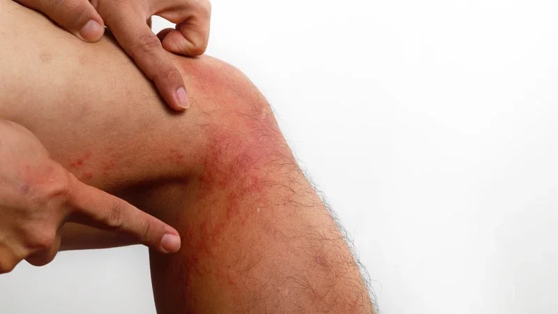 Hình ảnh sán chó trên da và dấu hiệu nhận biết ngứa da do sán chó - Trung tâm Tiêm chủng Long Châu (3)