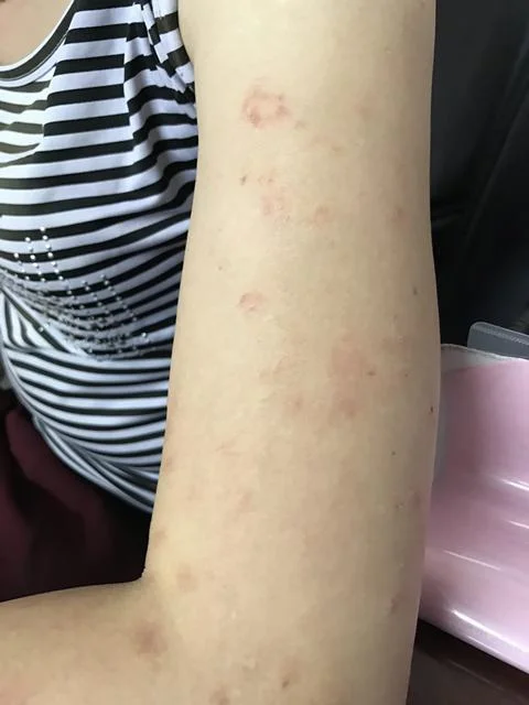 Những biểu hiện của bệnh sán chó