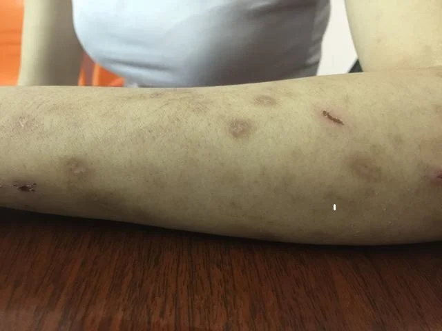 Dấu hiệu bị nhiễm sán chó Toxocara ở người và cách nhận biết