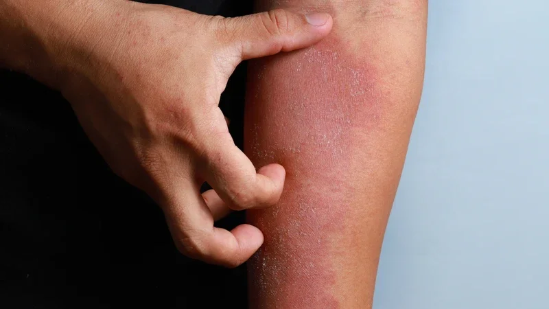 Hình ảnh sán chó trên da và dấu hiệu nhận biết ngứa da do sán chó - Trung tâm Tiêm chủng Long Châu (2)