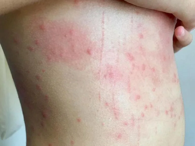 Bệnh sán chó: Dấu hiệu, Hình ảnh sán chó & Cách trị, Phòng ngừa