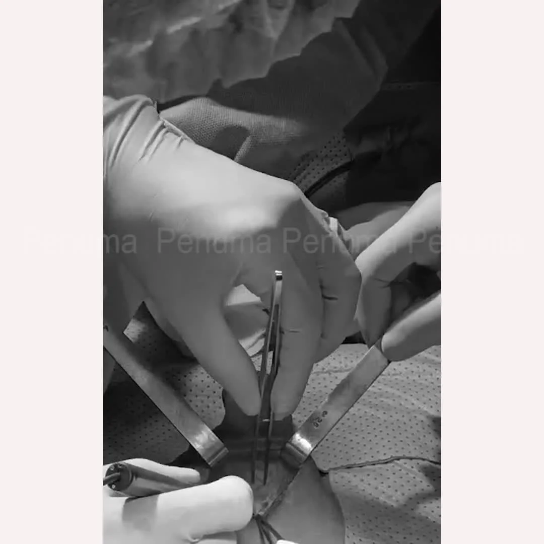 Phẫu thuật tăng kích thước cậu nhỏ, đường mổ ở mu - Nam khoa Penuma